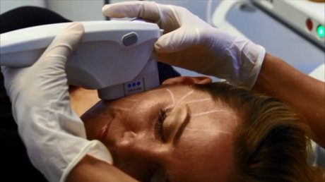Ultherapy treats the deep layers of skin tissue without disturbing the surface of the skin 