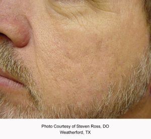 Laser Genesis Non-Ablative Skin Resurfacing