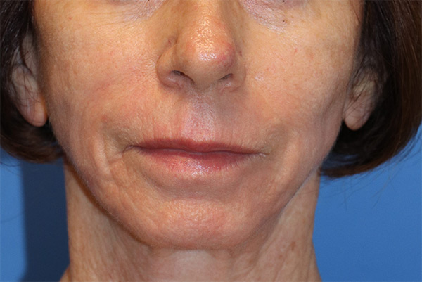 Pearl Fractional Full-Face and Ablative Resurfacing