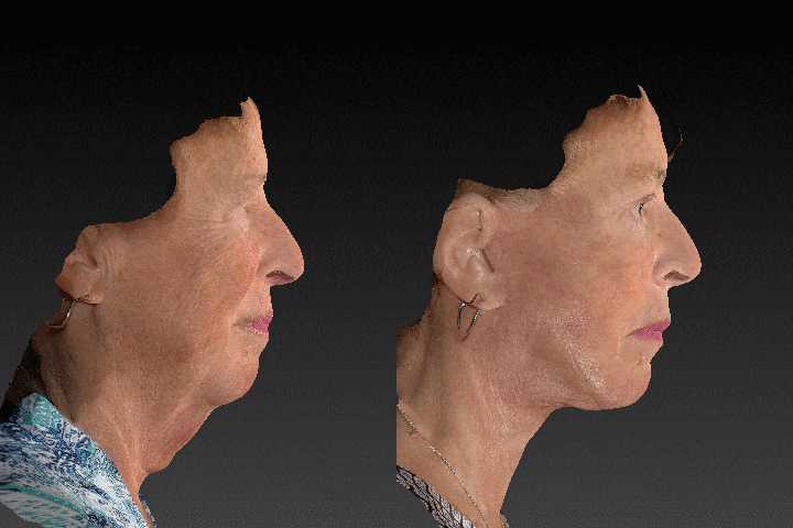 3D Before & After Result