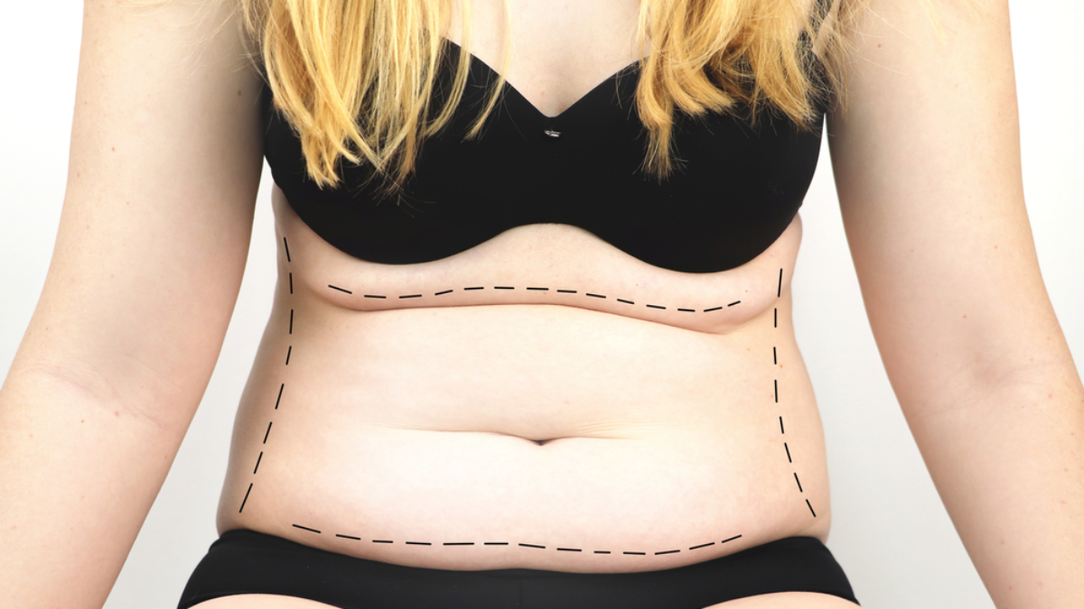 Can I Get a Tummy Tuck Without Liposuction?