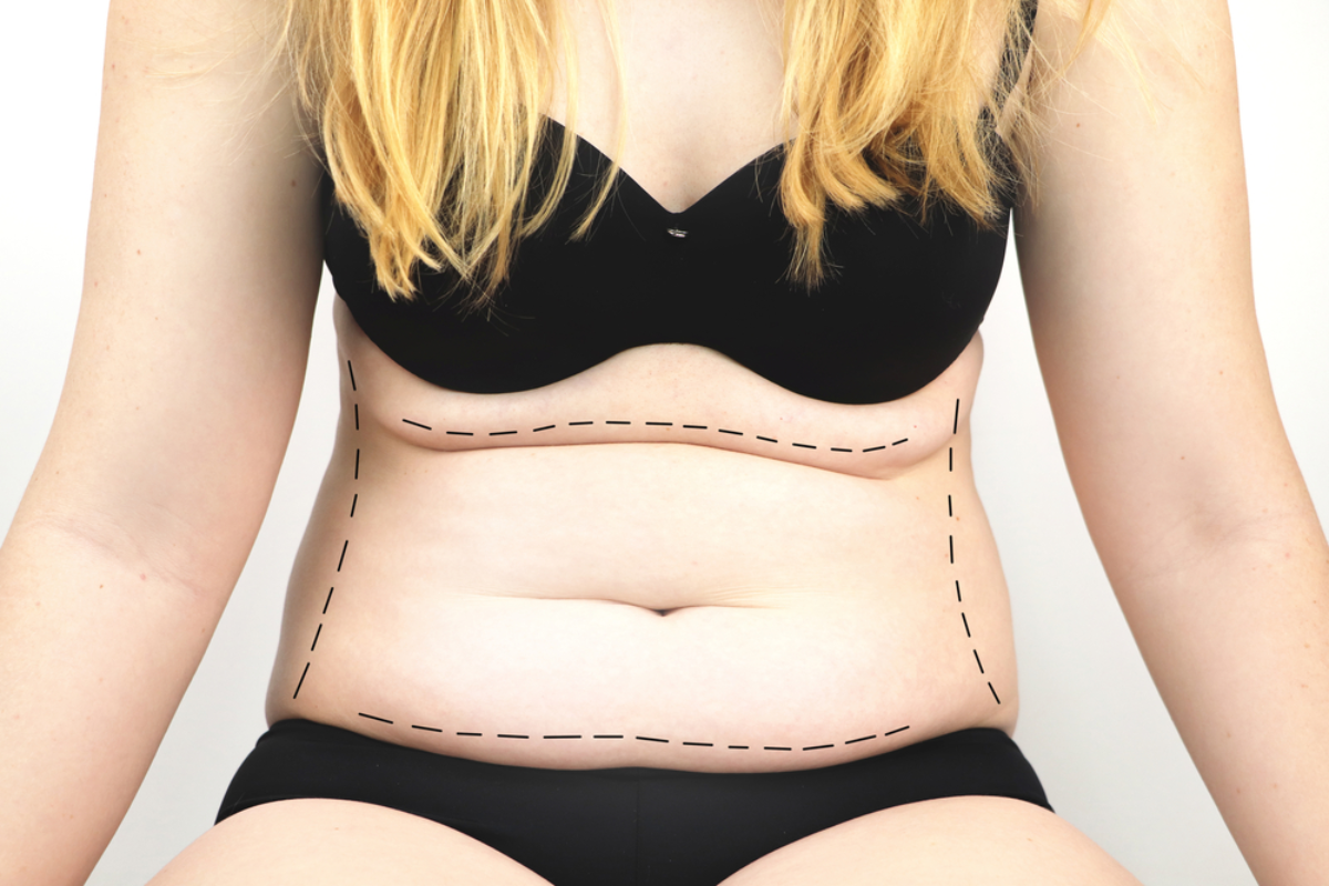 Reduce Your Belly Fat with Tummy Tuck Treatment