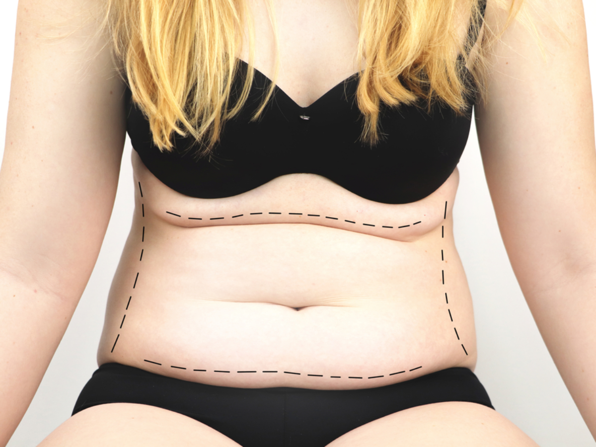 Has anyone had wonderful results from their tummy tuck? - Quora