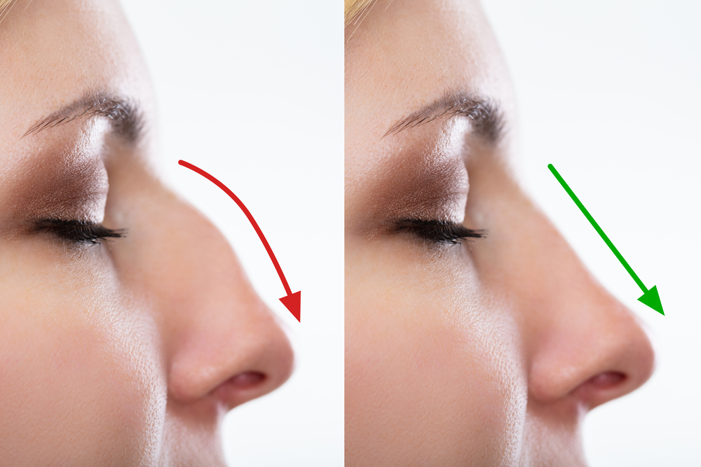 What Is a Rhinoplasty? - Athena Plastic Surgery