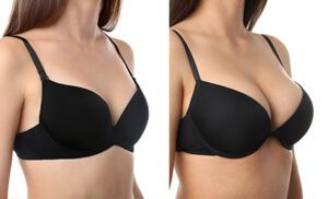 Breast Augmentation Sewells Point 