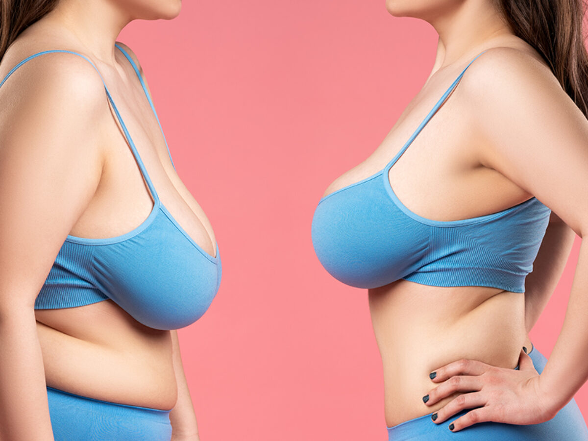 A breast reduction lifted a painful weight from my life